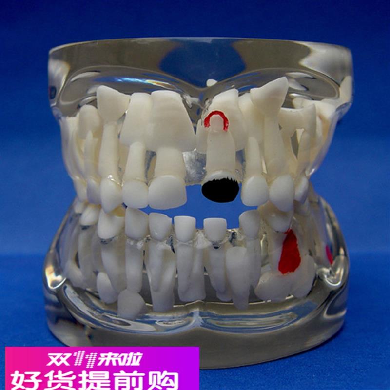 ENOVO颐诺儿童乳牙早期病态牙列模型 牙齿发育幼儿牙齿护理教学具