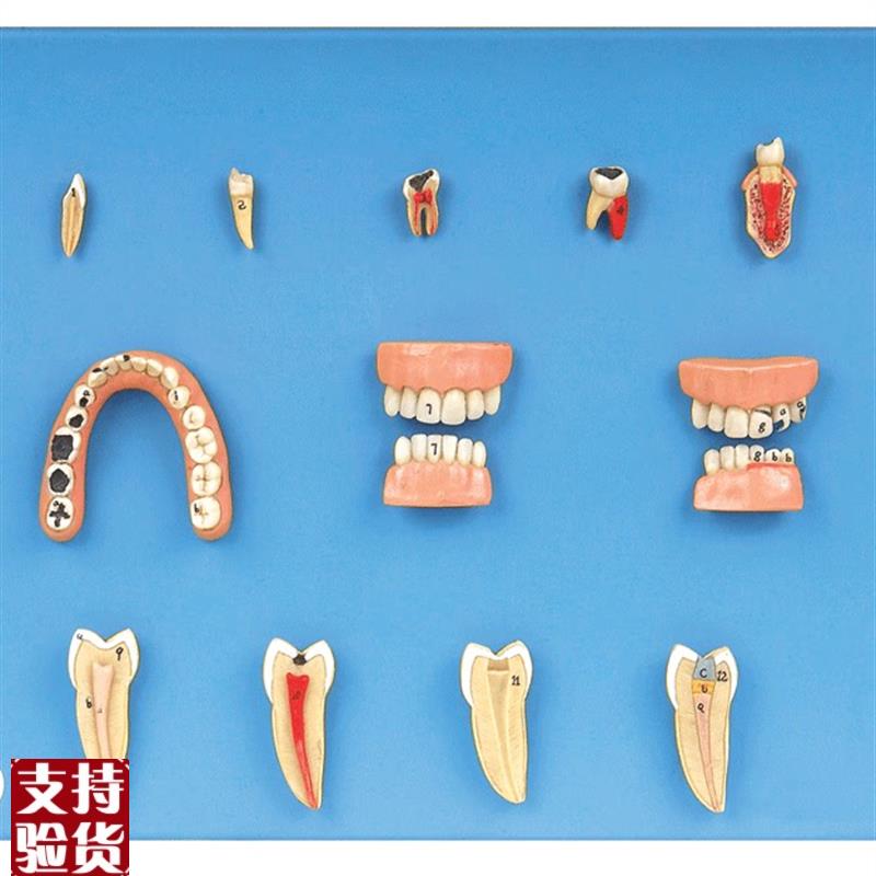 牙齿病变系列模型QB10017