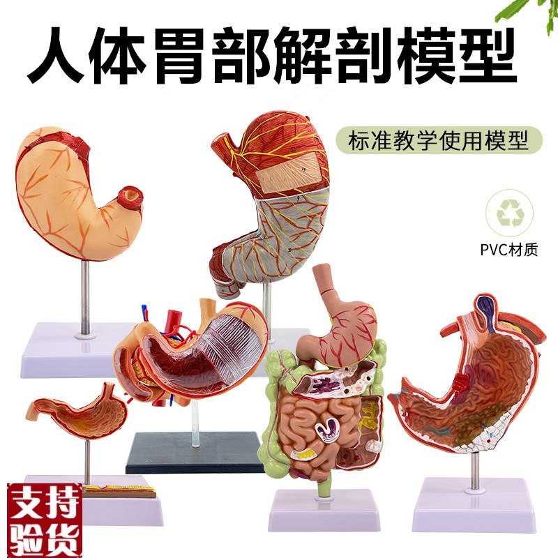 人体胃解剖模型胃的病变模型y胃部疾病胃的穿孔演示模型病理胃