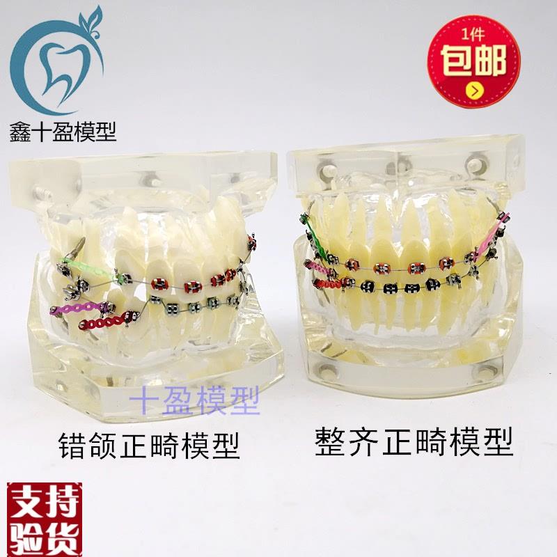 牙科正畸模型透明l错颌矫正展示模型结扎丝托槽正畸带支抗钉牙列