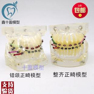 牙科正畸模型透明l错颌矫正展示模型结扎丝托槽正畸带支抗钉牙列