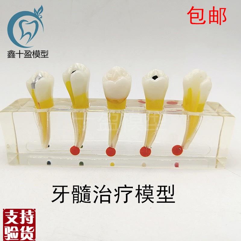 牙科口腔牙齿模型牙髓修复模型前磨牙牙体蛀牙根O管龋坏M4007-2