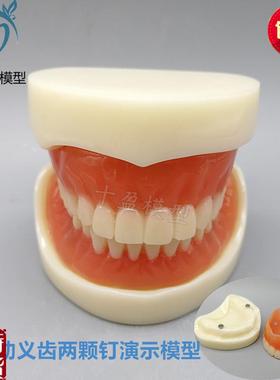 牙科模型活动义齿牙模讲解模型全口D义齿两颗钉教学模型T21包邮