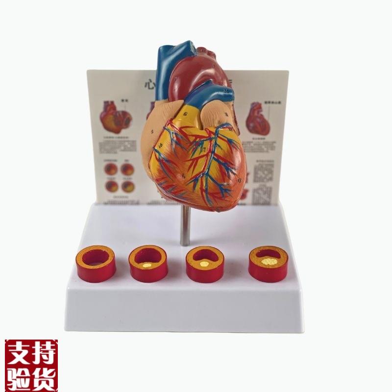 康泰模型心血管粥样硬化狭窄阻塞病理冠状动脉临床医药Z促销人体
