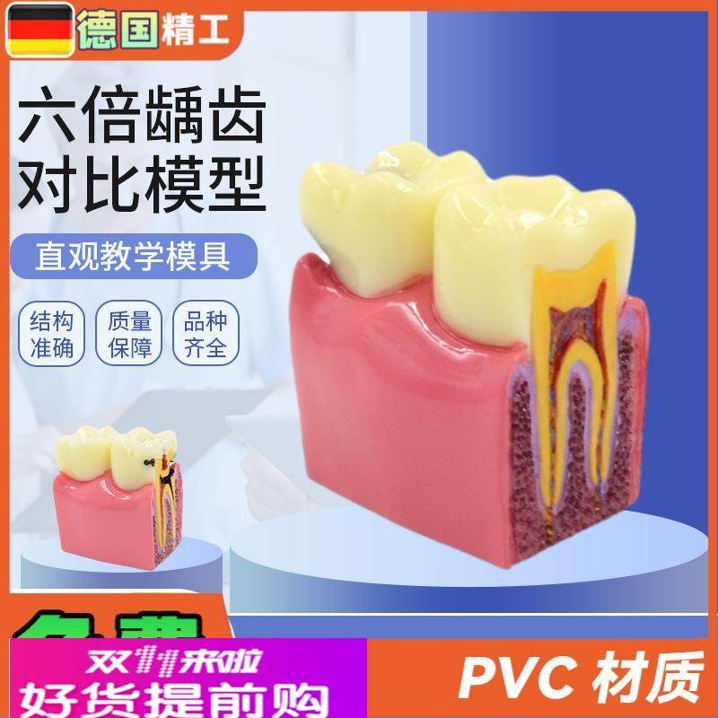 德国】六倍龋齿对比模型  口腔牙齿模型口腔教学蛀牙切面模型 牙