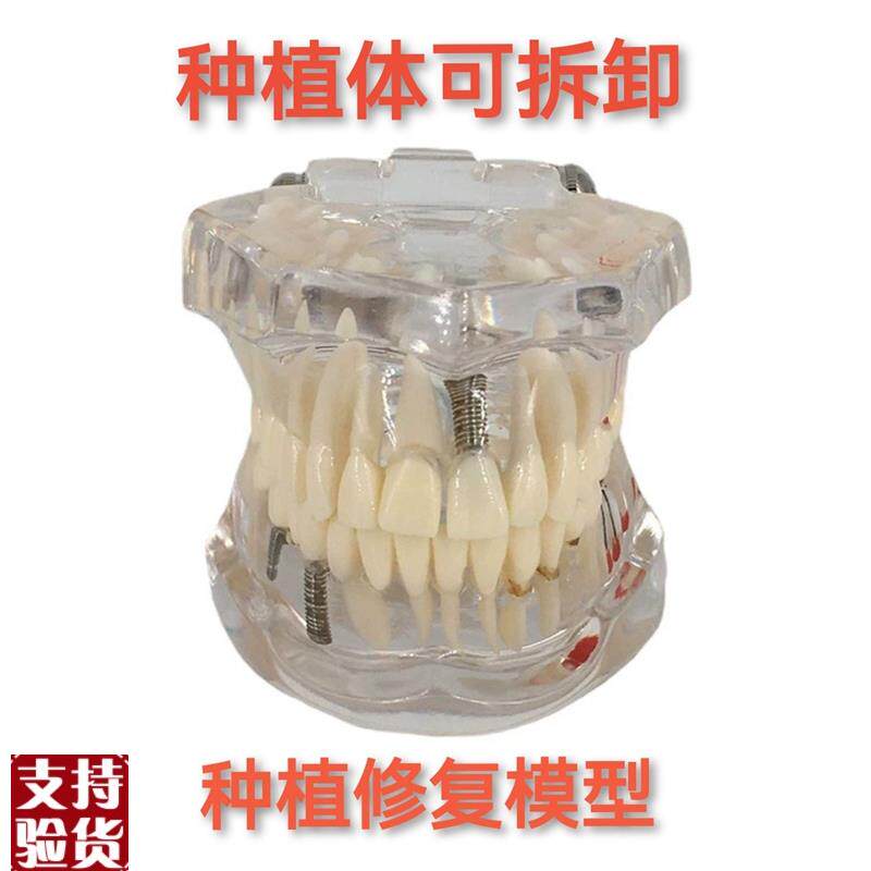 牙科材料修复牙模型水晶病理牙模型活P动种植牙模型包邮