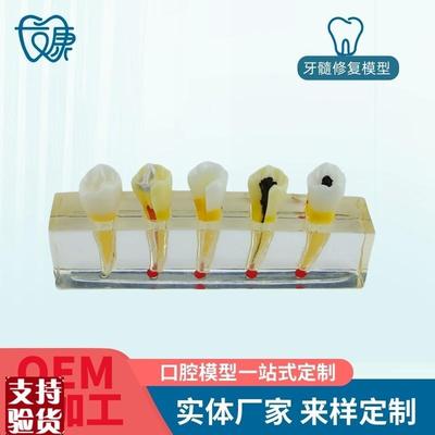牙科医患沟通病理模型牙髓病修D复模型展示牙髓牙髓治疗模型