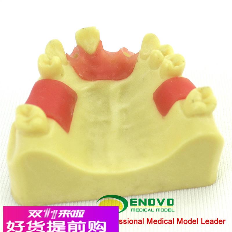ENOVO颐诺上颌缺失种植实训模型 口腔即刻种植操作上颌骨缺失牙齿
