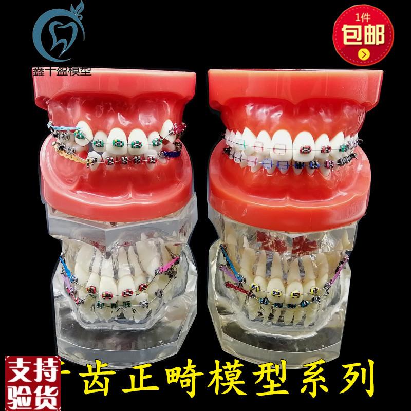 牙科正畸模型g透明错颌矫正展示模型结扎丝托槽正畸带支抗钉牙列