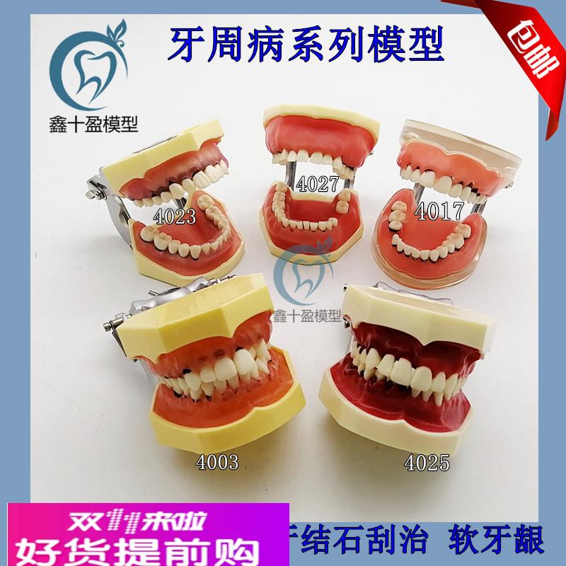 牙科口腔教学模型 牙周病理模型 练习刮治结石 牙周分类医患沟通