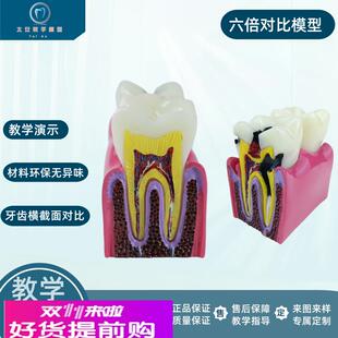 牙科口腔模型解剖放大蛀牙模具医患沟通六倍牙齿龋坏病理演示