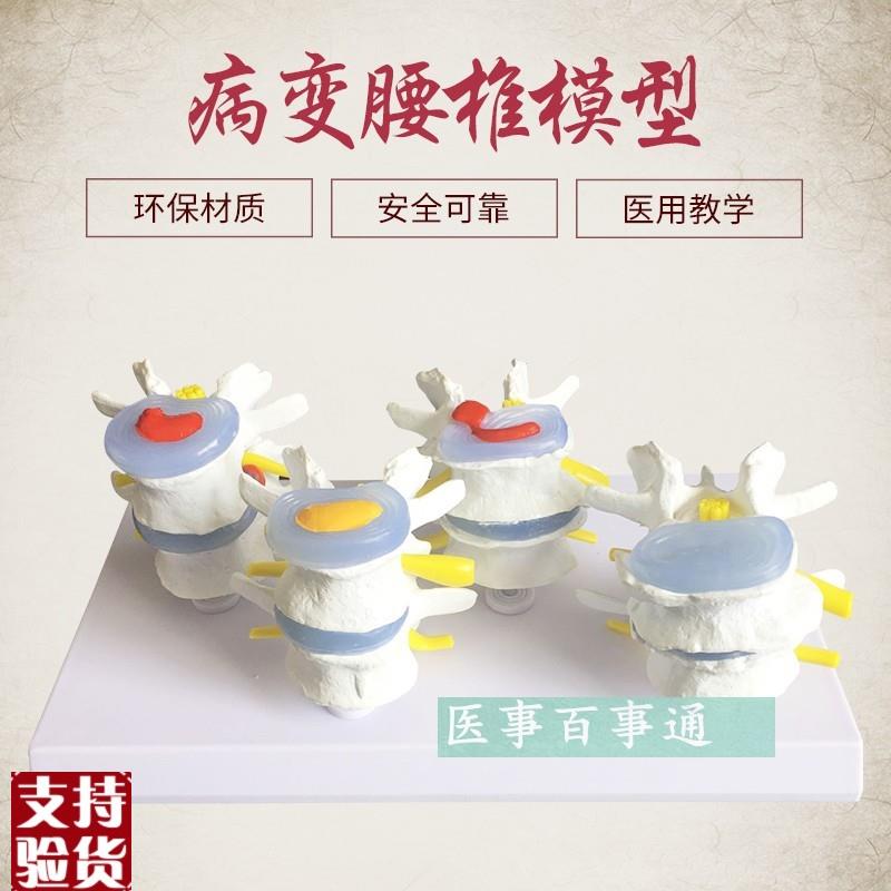 四分型脊椎正常与病变腰椎v组合模型椎间盘腰椎病理过程病变演示