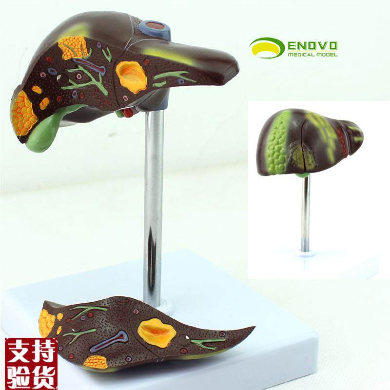 ENOVO颐诺乙肝肝p炎脂肪肝肝硬化肝脏模型消化科医学肝胆保健模型