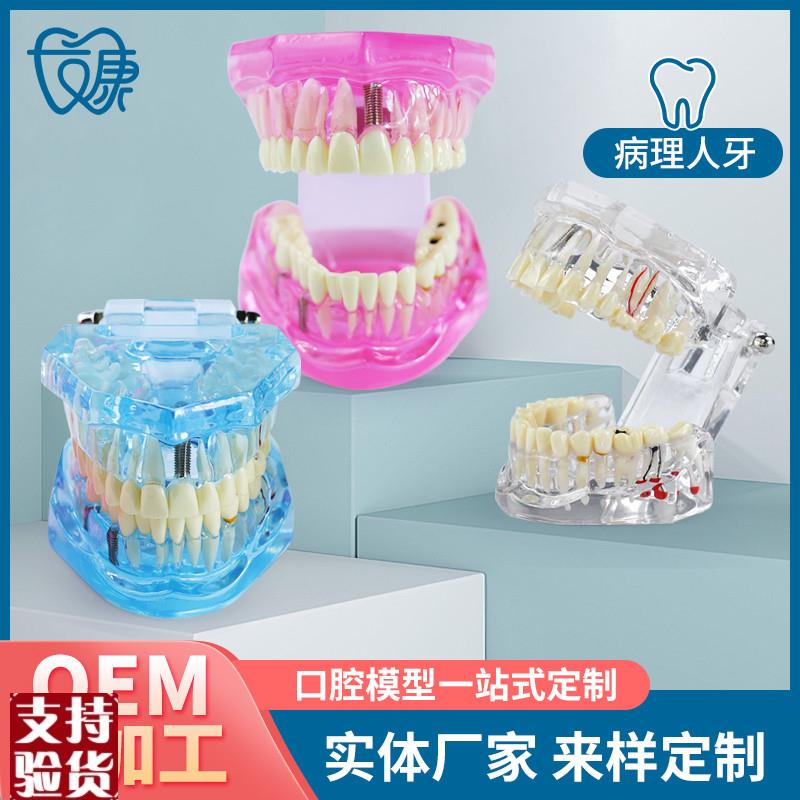 牙齿模型病理修i复可拆卸正畸口腔病理牙模型牙科医患活动沟通