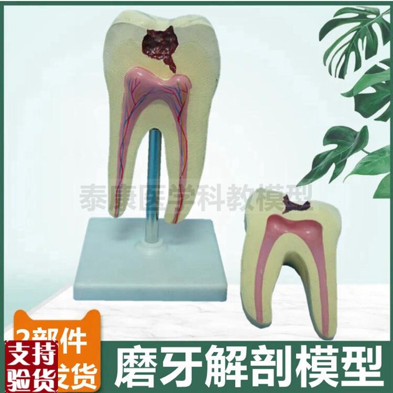 磨牙模型臼齿蛀牙可拆卸口腔牙科医用大牙解剖牙髓V牙根管牙齿护