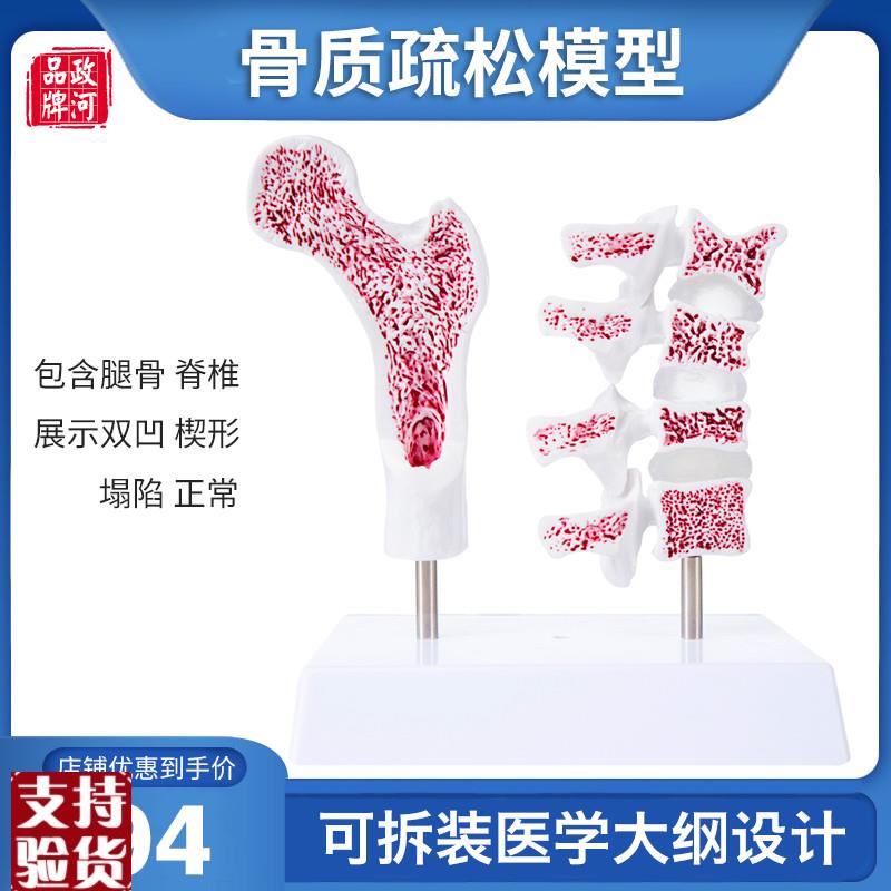 骨质疏松模型人体骨m骼教学模型股骨头脊椎双凹塌陷楔形病理病变