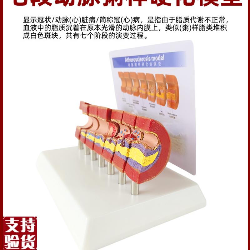 人体心脑血管动脉粥样硬化堵塞模型血F栓血液脂肪病理解剖医学教