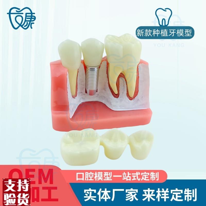 4倍种植牙模型种植体分析冠演示E牙模型种植体模型口腔教学模