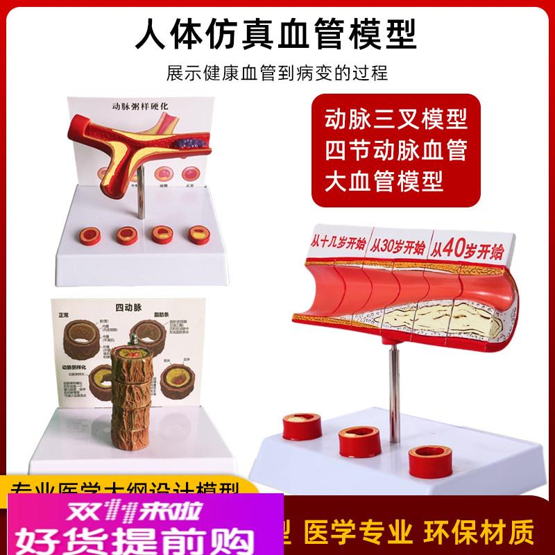 人体心血管层次结构解剖堵塞模型血栓脂肪病理动静脉放大硬化教具