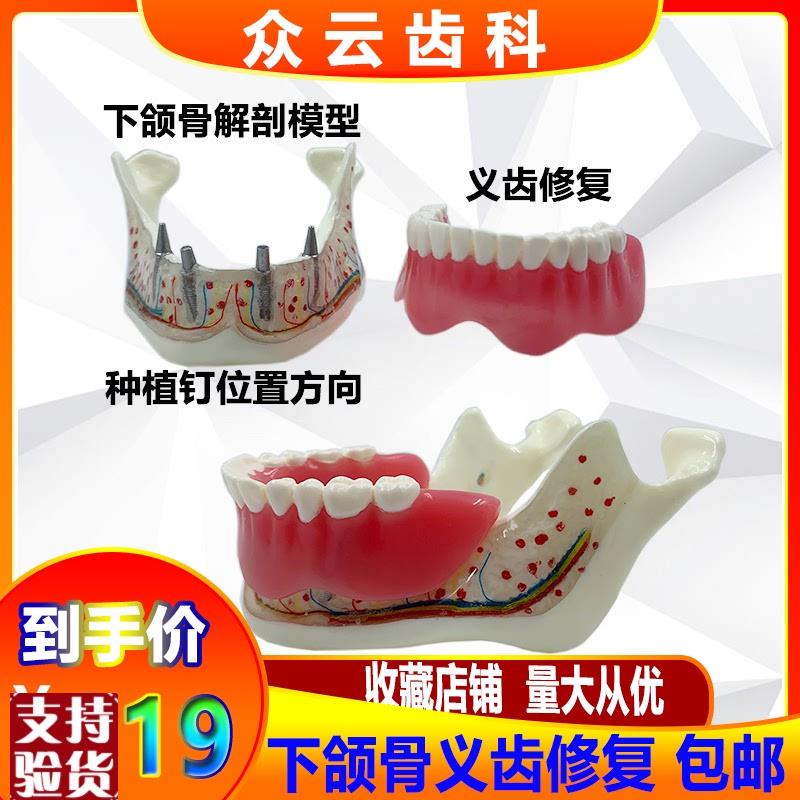 牙科口腔下颌骨神经义齿修复覆盖模型可拆卸医患沟通讲Z解模型包