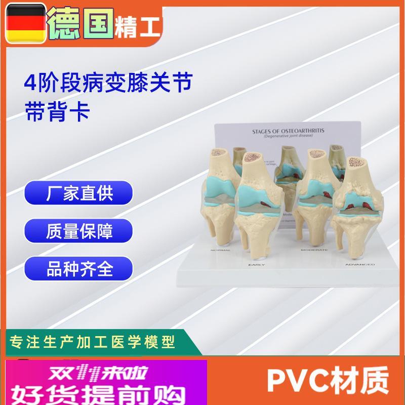 4阶段膝关节模型带背卡病变膝关节模型 骨科教学展示教具