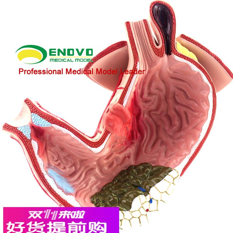 颐诺正品医用胃部疾病演示模型人体胃解剖消化系统模型消化科