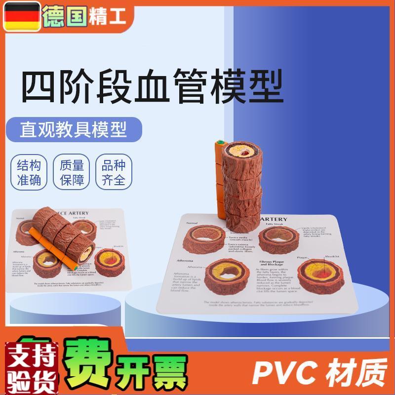 德国】血管模g型人体四阶段血管标本心内科医患沟通演示血管硬化