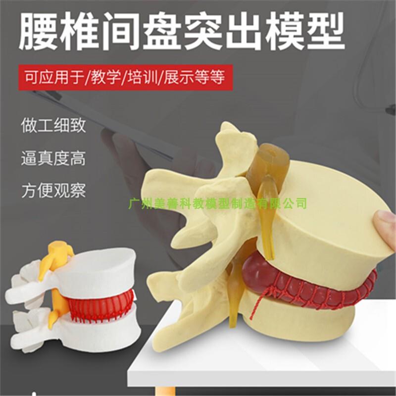 腰椎放大腰椎间盘模型挤v压突出演示脊柱脊椎骨病理演示模型