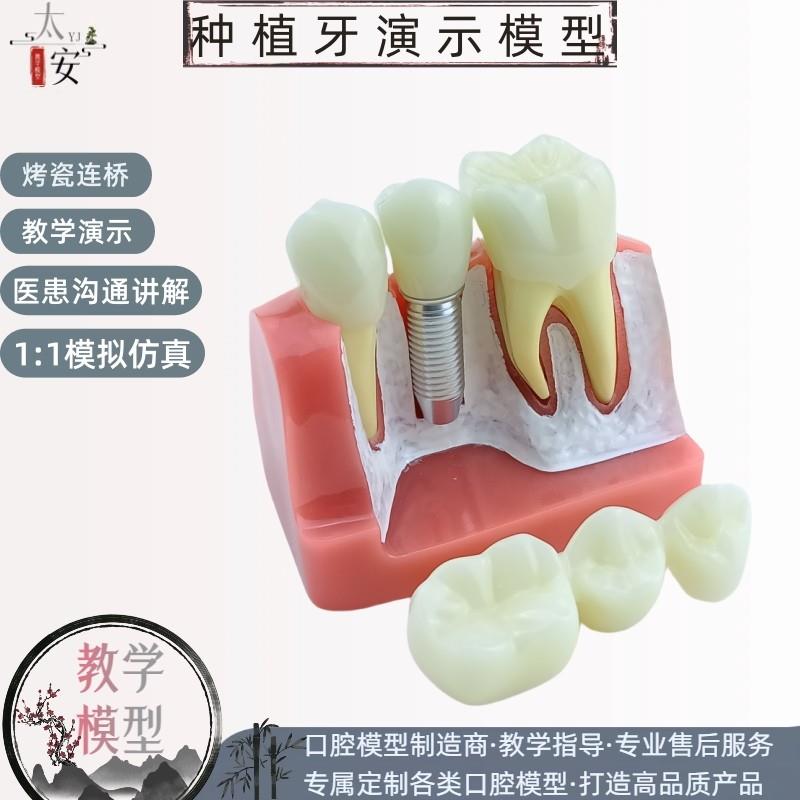 牙科口腔种f植模型演示模型医患沟通教学练习种植牙模型