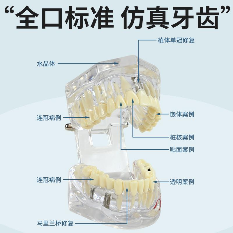 牙科修复模型口腔科病理医v患沟通教学修复体综合带神经可拆卸牙