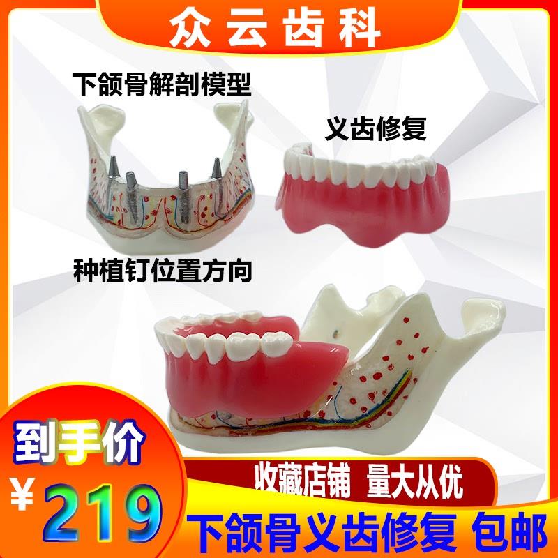 牙科口腔下颌f骨神经义齿修复覆盖模型可拆卸医患沟通讲解模型包