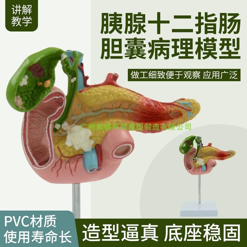 仿真教学胰腺h十二指肠胆囊病理模型胆结石外科消化系统模型