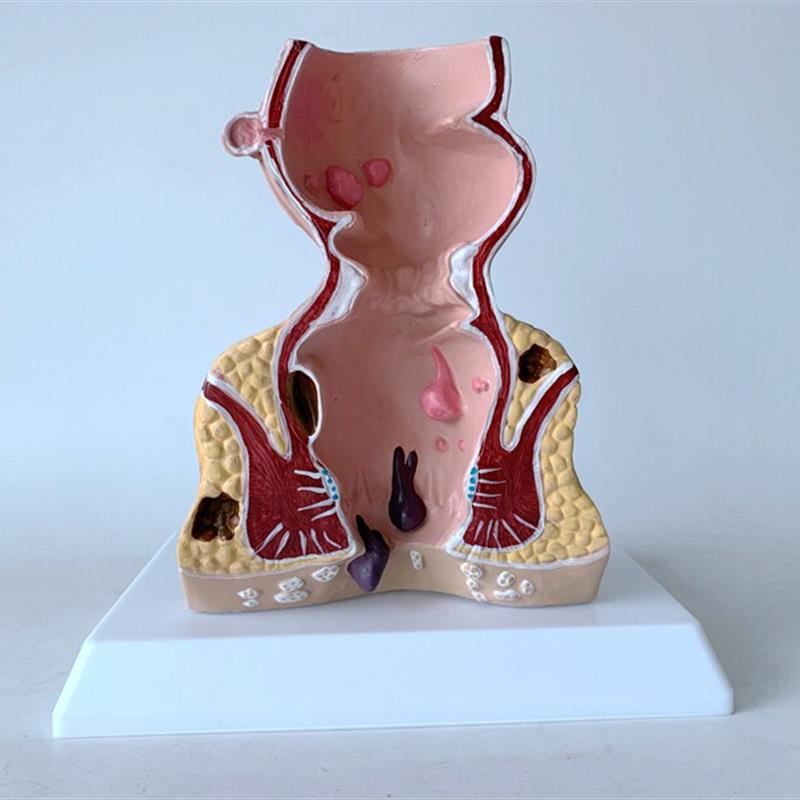 直肠痔疮病变模型痔疮内外解剖肛门肛肠科大肠直Y肠病理模型