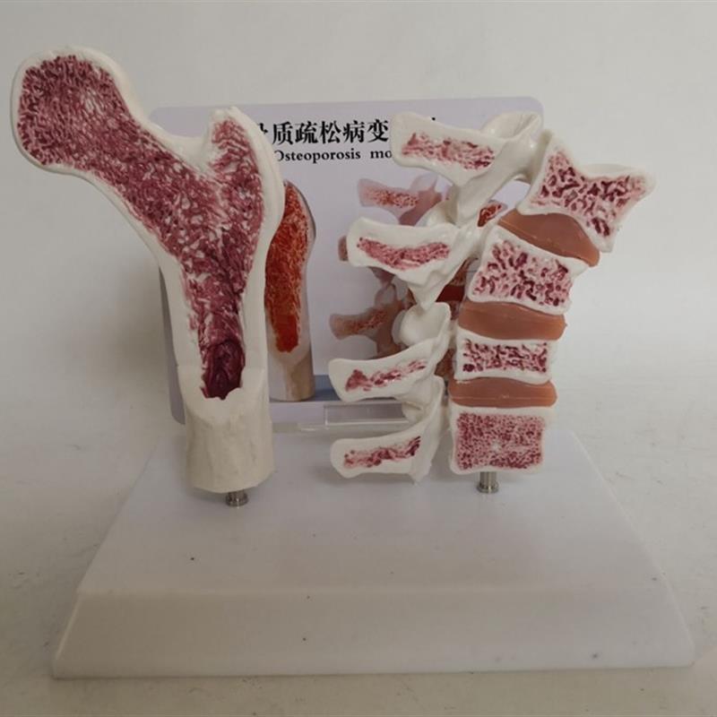 人体骨质疏松比较模型股骨头骨骼骨架脊O椎解剖病变讲解模型