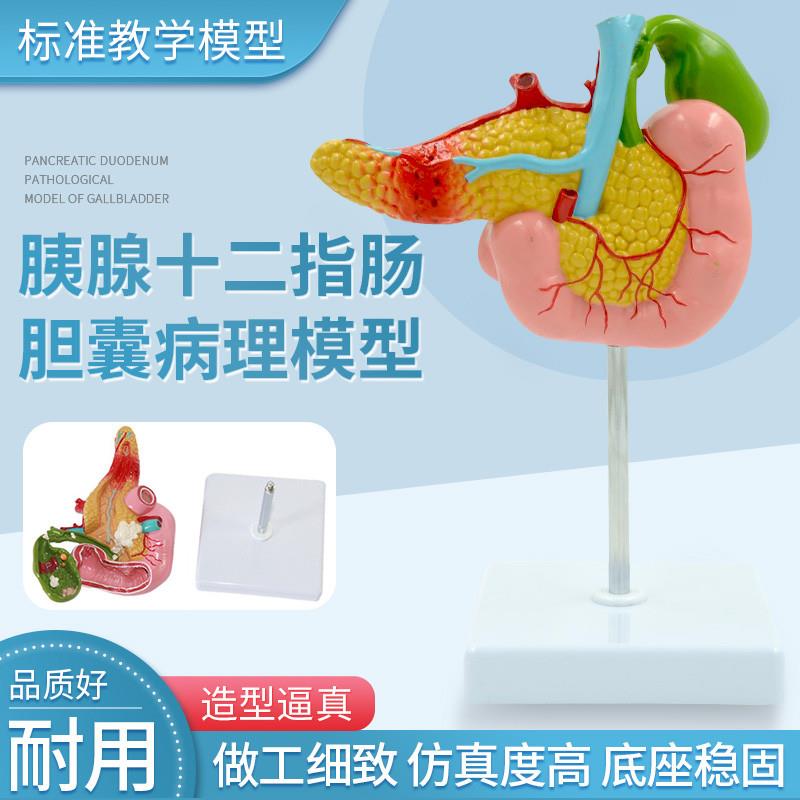 医学胰腺十二指肠胆囊病理模型胆结石M外科消系统肝胆科模型