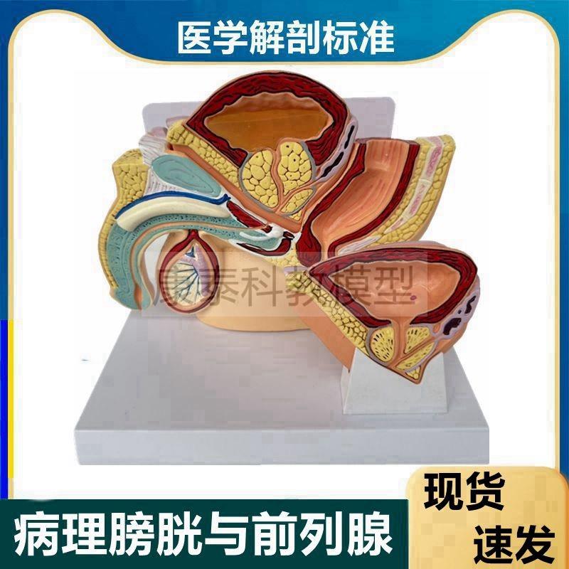 男性前列腺模型健康病变增大肥男科医患H桌上型盆腔病理膀胱泌尿