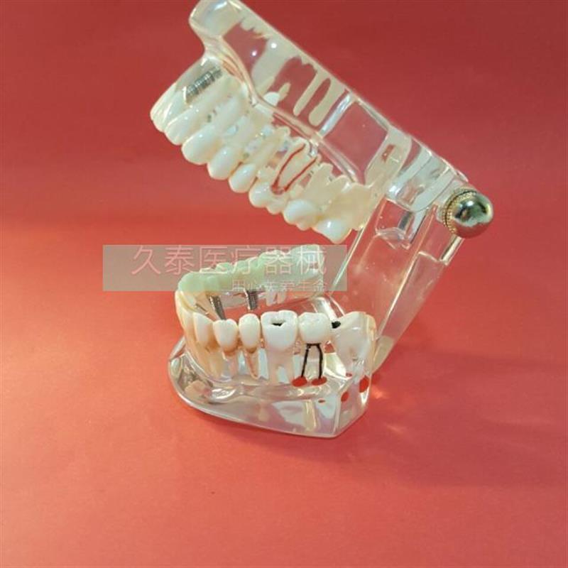 牙齿模型成人透明病理种植修z复模型牙科模型(包邮)口腔模型