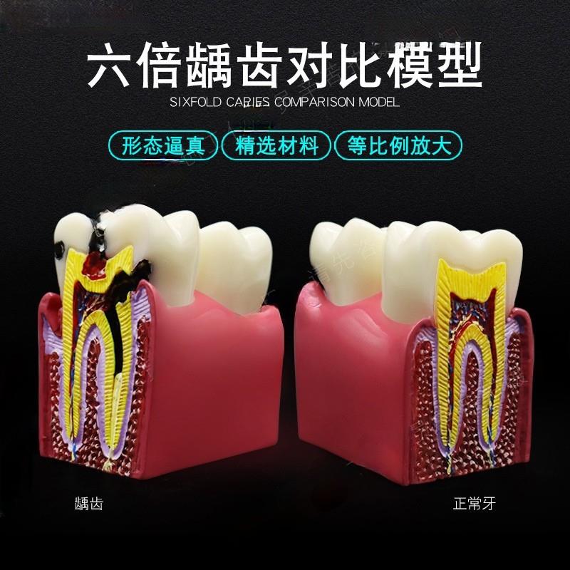 牙科口腔模型解剖放大蛀v牙模具医患沟通六倍牙齿龋坏病理演示
