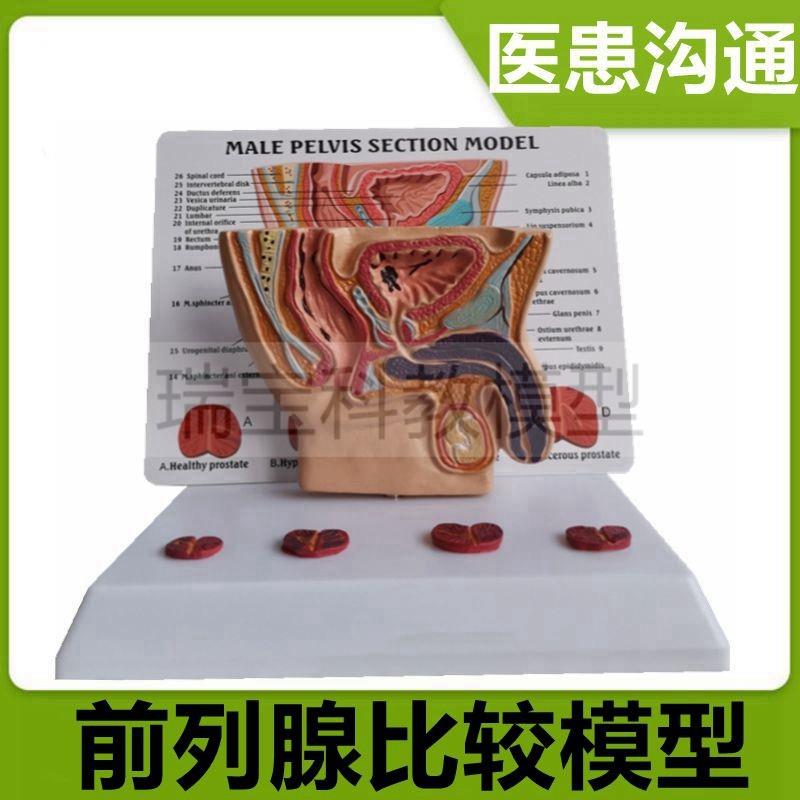 男盆腔模型泌尿j生殖器官前列腺膀胱尿道变化狭窄老年人男科医患