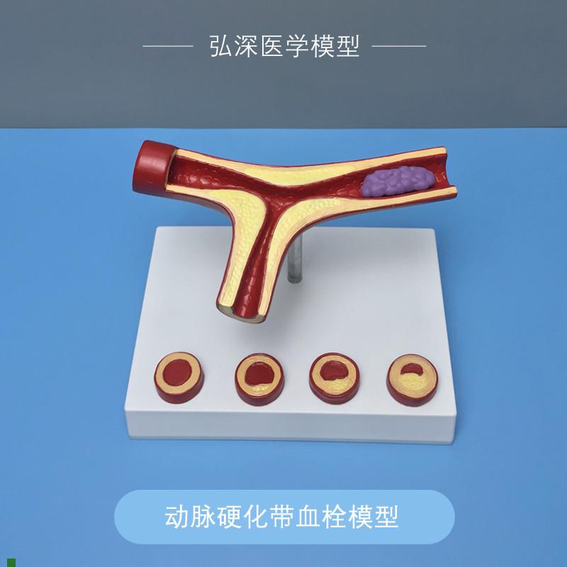 血管模型人体动脉硬化带血栓w粥样化病变过程展示教学心内医学讲