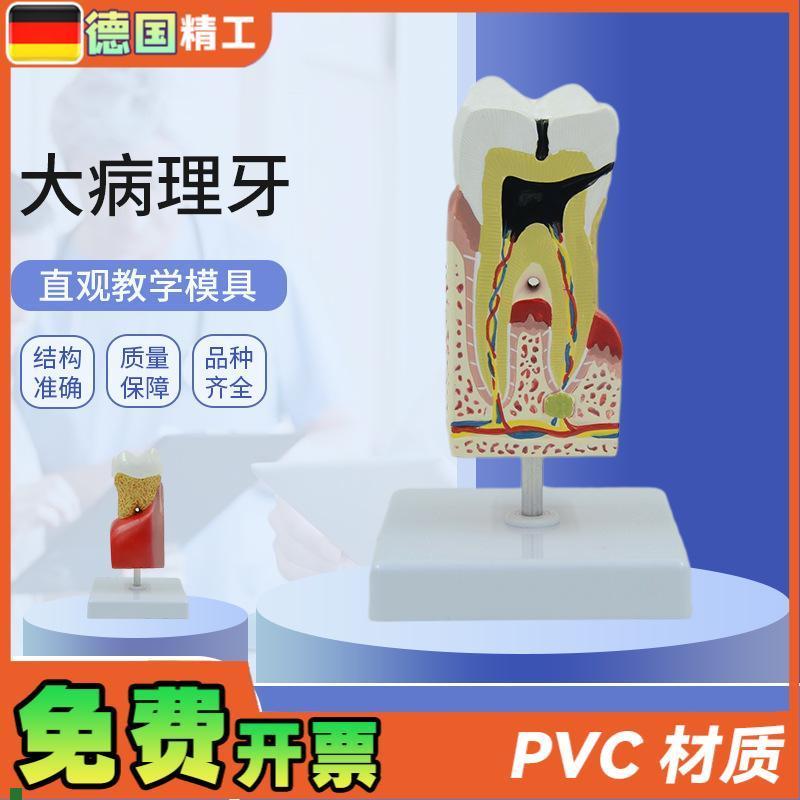 德国】人体e大病理牙齿模型蛀牙模型蛀牙放大牙齿解剖病理牙病