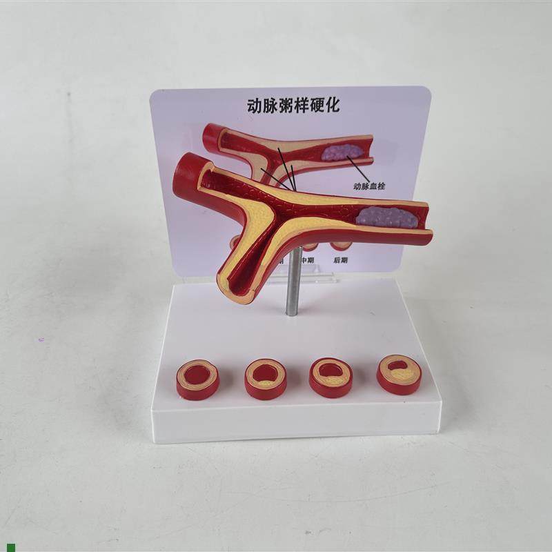 人体血管病理粥样动脉/硬化模y型病变血栓/血管/病演示心解剖教具