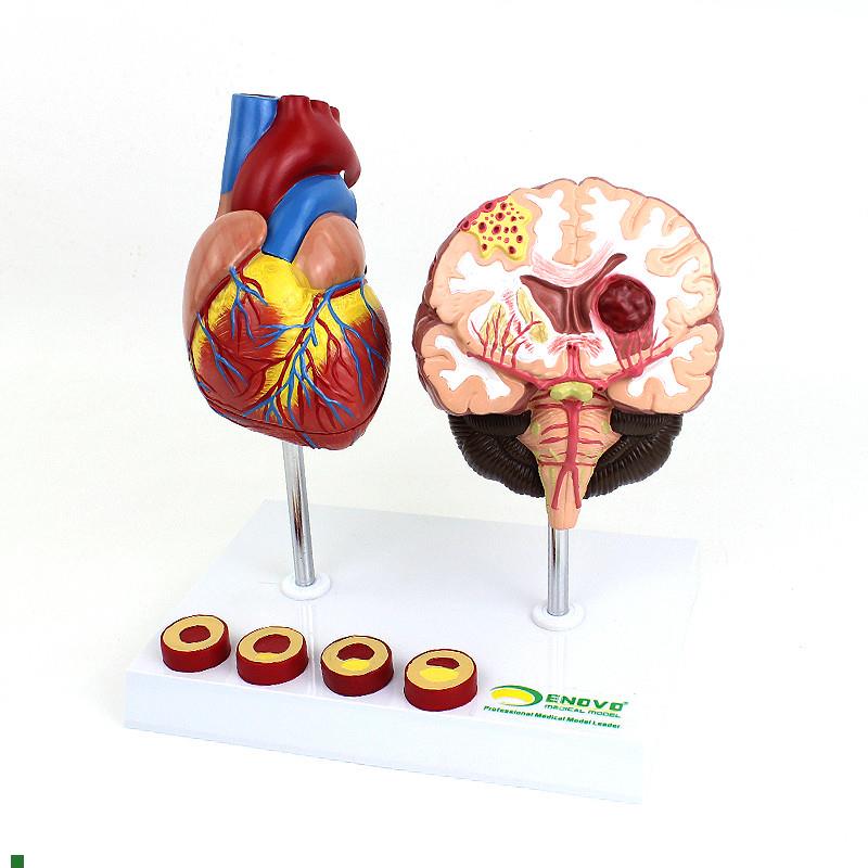 适配ENOVO颐诺心脑血管疾病展示模型高血压心脏心血管疾病模型脑