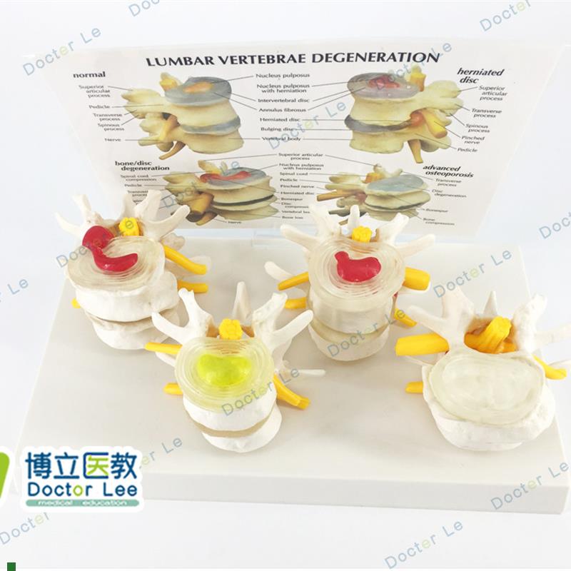 四分型腰椎d模型正常与腰椎病变组合模型医学人体骨骼腰椎模型