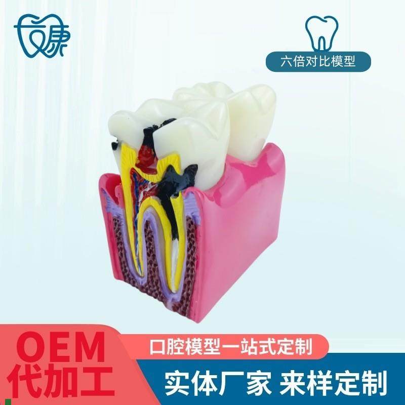 6倍对比模型f牙科教学器材6倍龋齿对比模型口腔模型教学牙齿模型