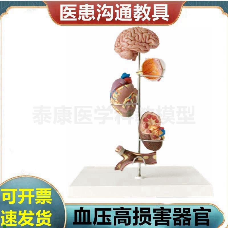 心脑血管模型血液压力升t高病理脏器受损糖尿眼底肾脏冠状动脉阻
