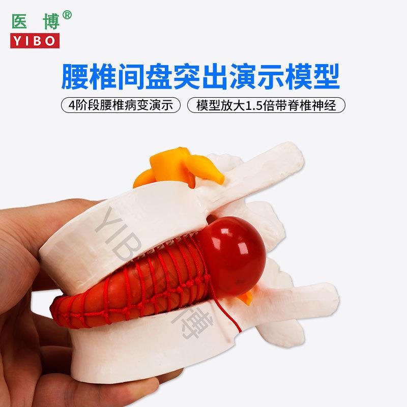 医博BIX-A3561人体腰椎间盘突出病变演示模型人体脊柱腰J椎模型人
