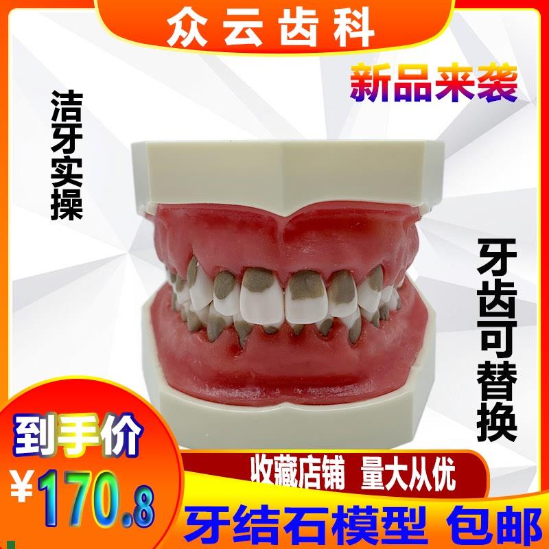 牙科口腔练习牙结石龈上龈下刮治模型牙结P石牙周病理牙齿模型