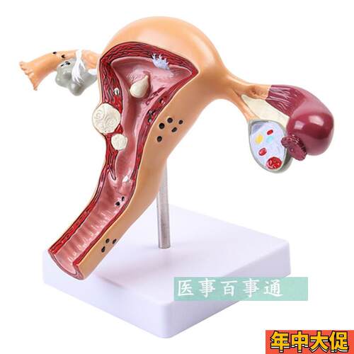 子宫卵巢病理病变模型生殖科医药礼品模型R女性子宫阴道模型