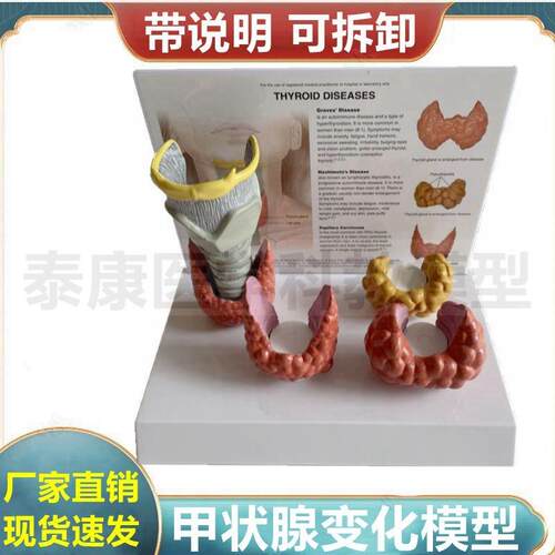 甲状腺模型 病j理比较肿内分泌器官临床医患沟通医药礼品喉咙解剖